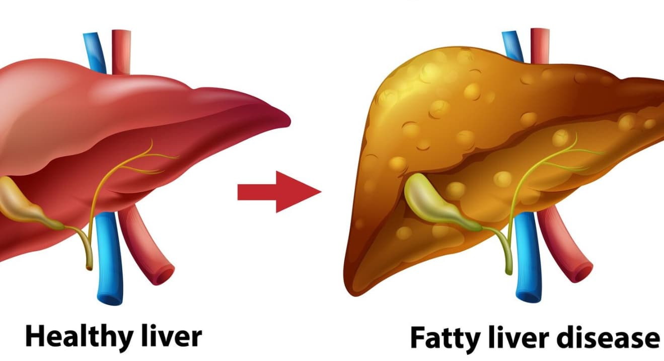 Fatty Liver Disease Symptoms